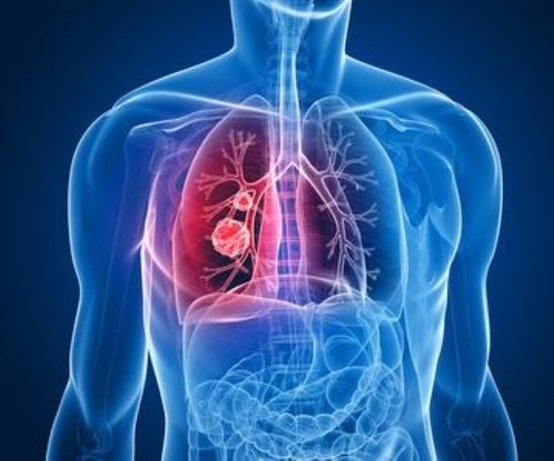 El cáncer poco común: Pleural Mesothelioma
