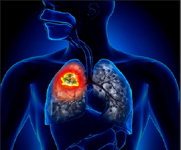 Que es la mesotelioma pleural o pleural mesothelioma