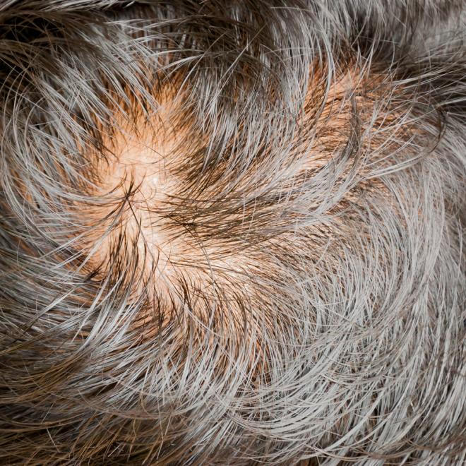 Tratamiento para del cabello. Top 2 remedios caseros para la caída del cabello