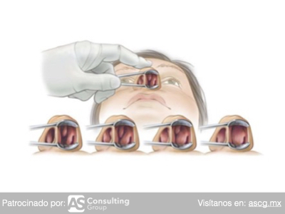 Qué es la Turbinoplastia y en qué consiste