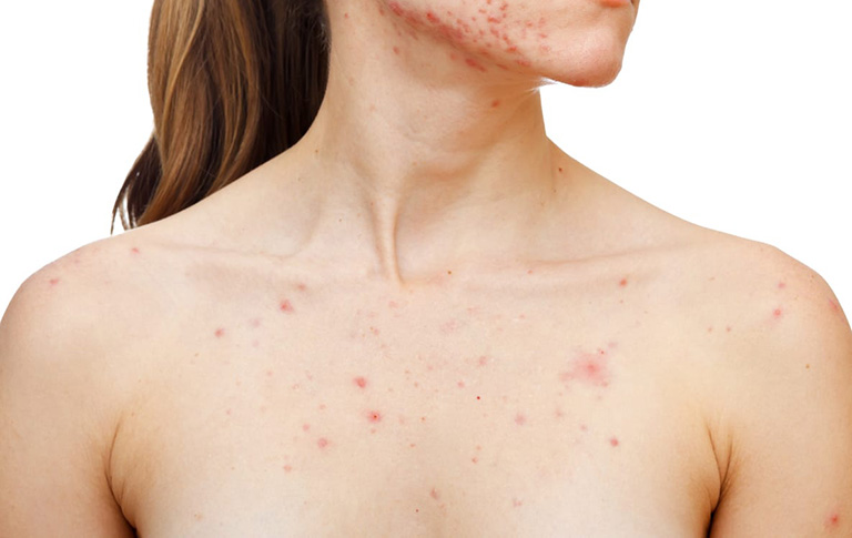 Todo lo que debes saber sobre el linfoma cutáneo