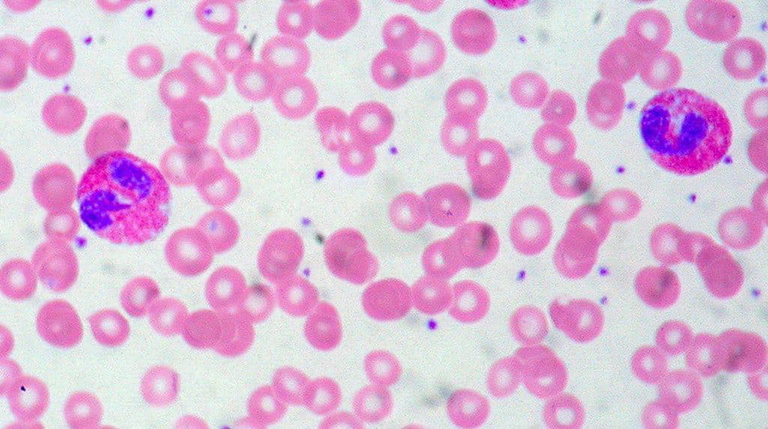 Qué es la eosinofilia y qué la causa